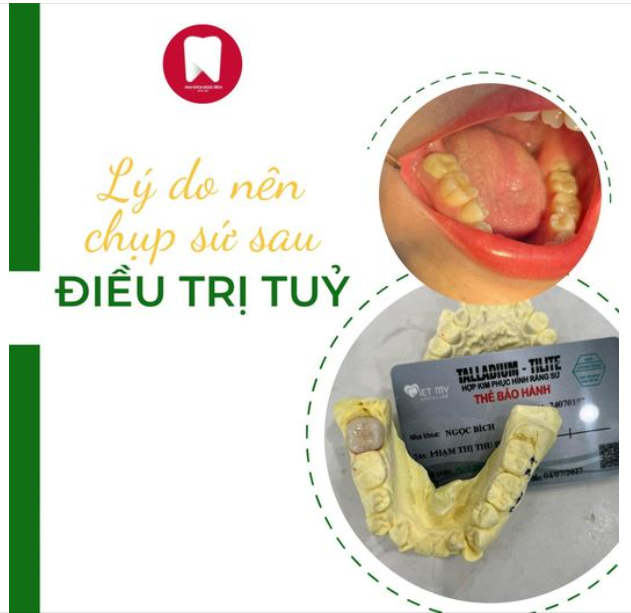 5 LÝ DO NÊN BỌC SỨ CHO RĂNG SAU ĐIỀU TRỊ TUỶ