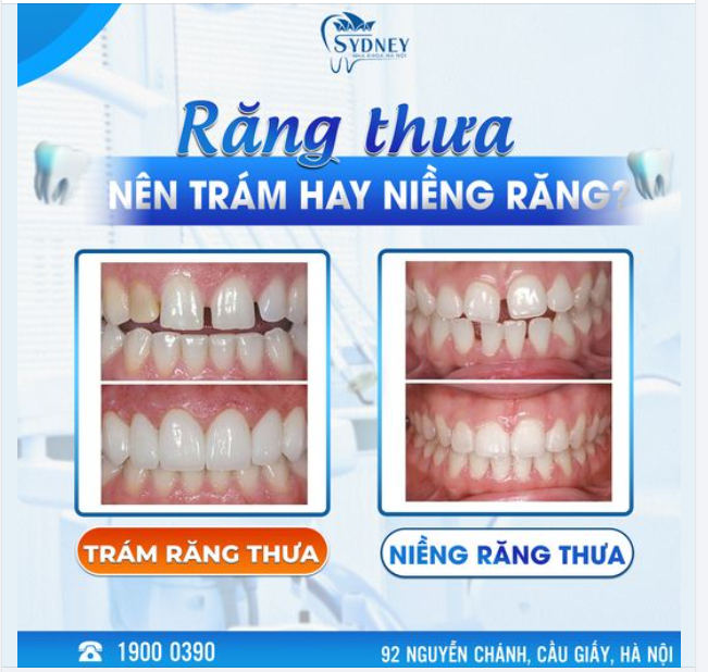 RĂNG THƯA NÊN TRÁM HAY NIỀNG RĂNG?