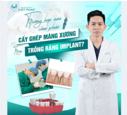 TRƯỜNG HỢP NÀO CẦN PHẢI CẤY GHÉP MÀNG XƯƠNG TRONG TRỒNG RĂNG IMPLANT?