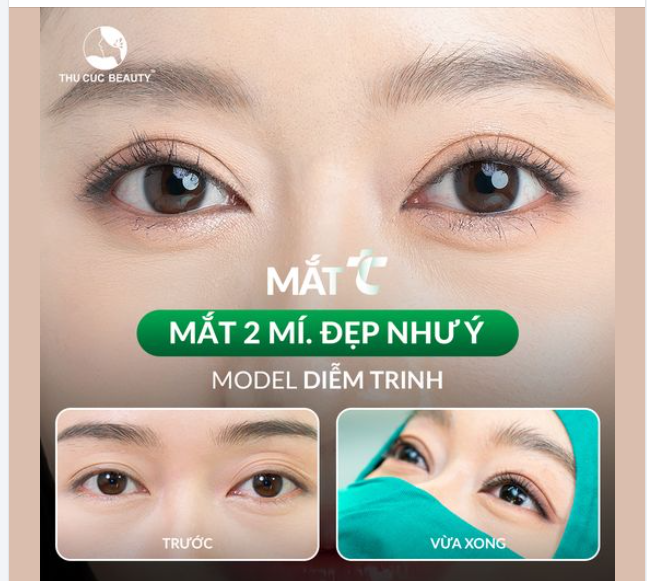 Đừng để tình trạng đa nếp mí khiến nhan sắc bạn bị "phong ấn"