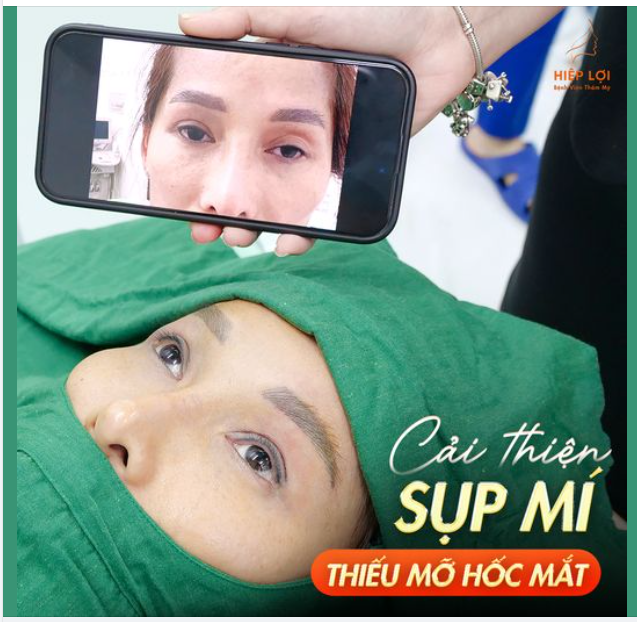 Sau 45p - Cải thiện rõ rệt tình trạng "sụp mi" và thiếu mỡ hốc mắt