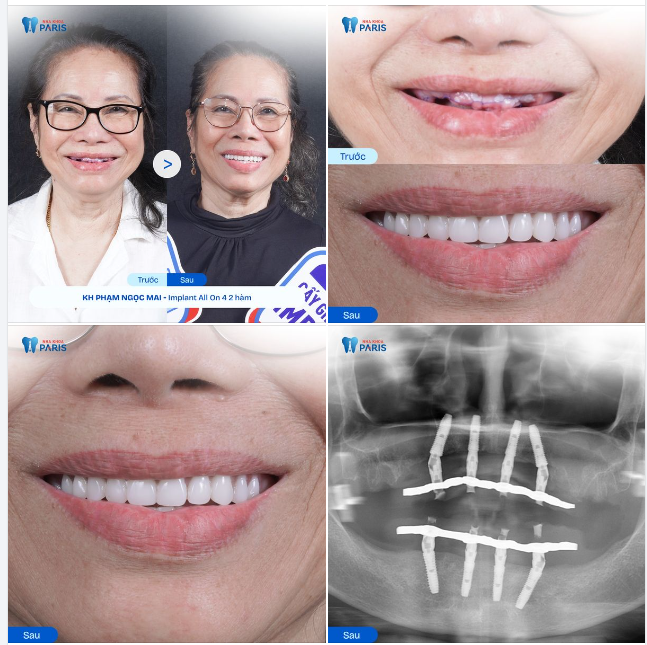 VỀ VIỆT NAM TRỒNG RĂNG IMPLANT: HÀNH TRÌNH KHÔI PHỤC NỤ CƯỜI VÀ SỨC KHỎE