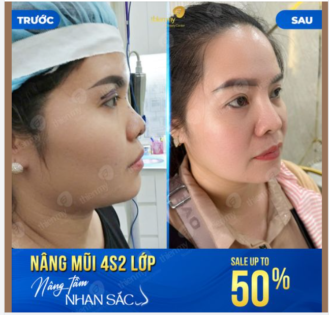 Nâng mũi 4S 2 lớp  - Nâng tầm nha sắc