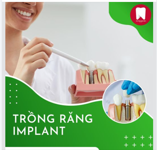 TOP 3 LỢI ÍCH KHI PHỤC HÌNH IMPLANT SỚM