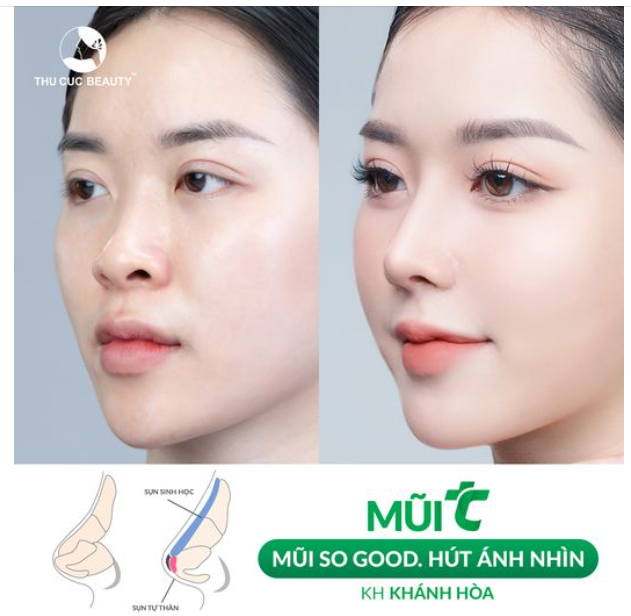 Thẩm mỹ TC giải cứu sống mũi thấp, đầu mũi tẹt 