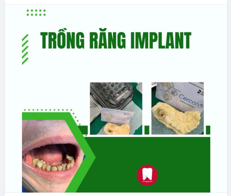 MẤT RĂNG KHÔNG CHỈ MẤT ĐI TỰ TIN MÀ CÒN MẤT ĐI SỨC KHỎE