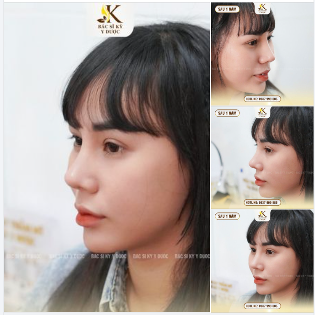 KẾT QUẢ NÂNG MŨI ALINE SAU 1 NĂM - DÁNG MŨI THANH TÚ, FORM ỔN ĐỊNH