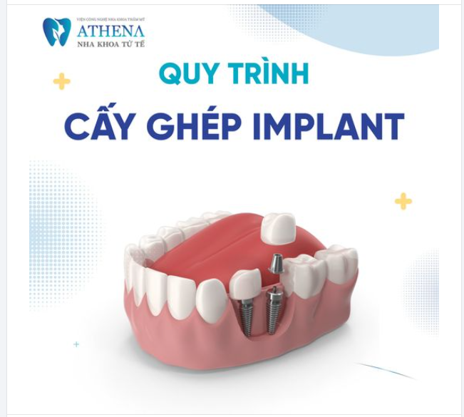 Cấy ghép implant là quy trình phục hồi răng mất hiệu quả và bền vững, mang lại nụ cười tự nhiên và cải thiện chức năng nhai.