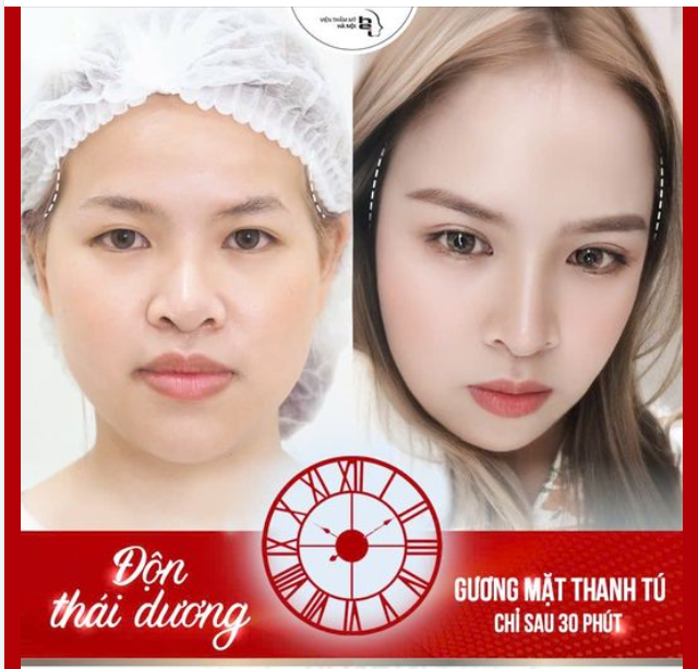Tại sao phải thực hiện Độn thái dương?