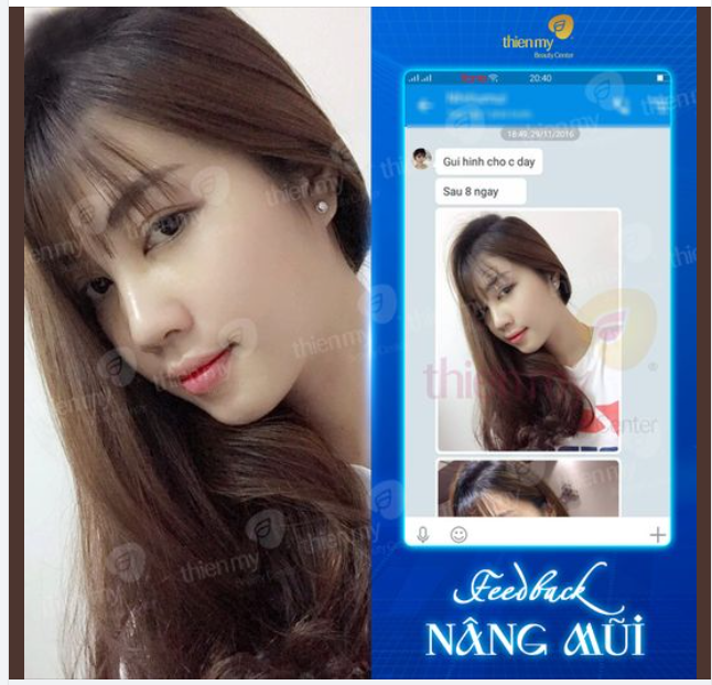 Feedback nâng mũi tại PKCK Thiện Mỹ