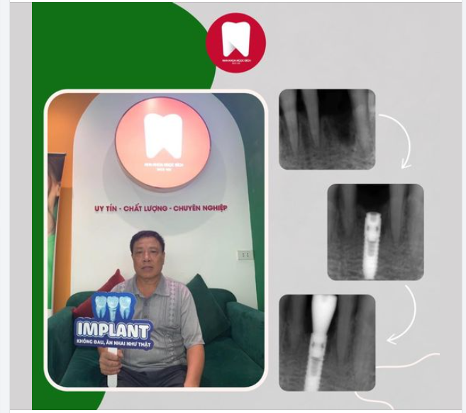 VAI TRÒ CỦA HEALING TRONG CẤY GHÉP IMPLANT