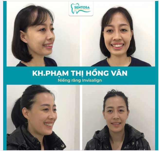 HOÀN THÀNH NỤ CƯỜI SAU 18 THÁNG NIỀNG INVISALIGN