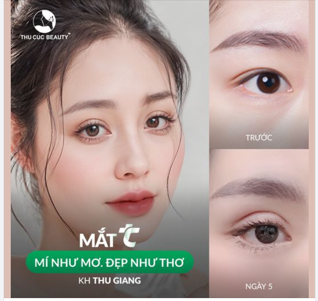  ​​​​​​​ Chỉ 15P thực hiện - 3 ngày vào form.Loại bỏ tình trạng mí sụp, da chùng, bọng mỡ...