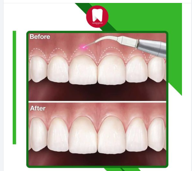 TRƯỜNG HỢP NÊN CẮT NƯỚU THẨM MỸ
