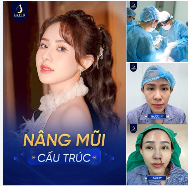 NÂNG MŨI CẤU TRÚC - Bí quyết thăng hạng nhan sắc