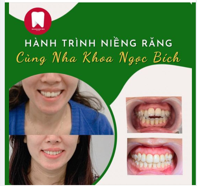 NGOÀI 30 TUỔI CÓ NIỀNG RĂNG ĐƯỢC KHÔNG