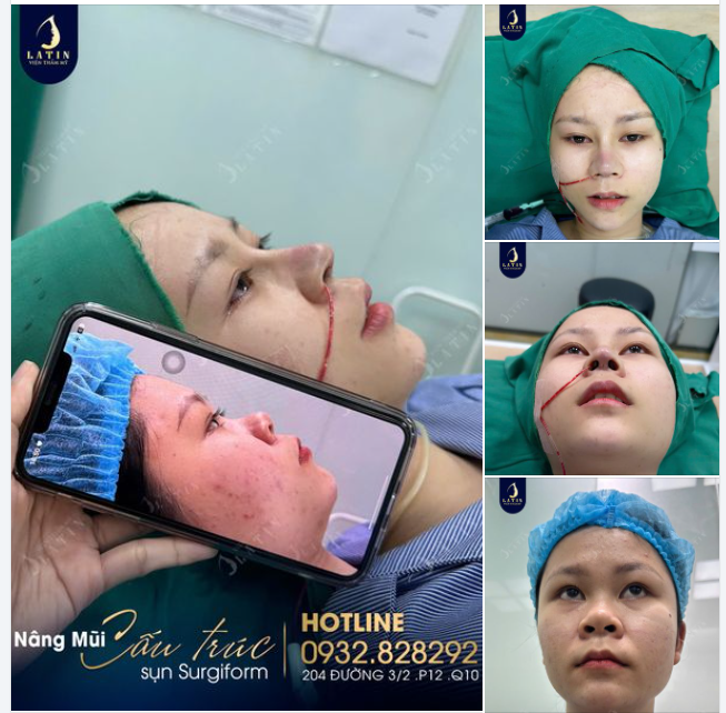 Kết quả nâng mũi cấu trúc sụn tai, sóng surgiform vừa hoàn thành