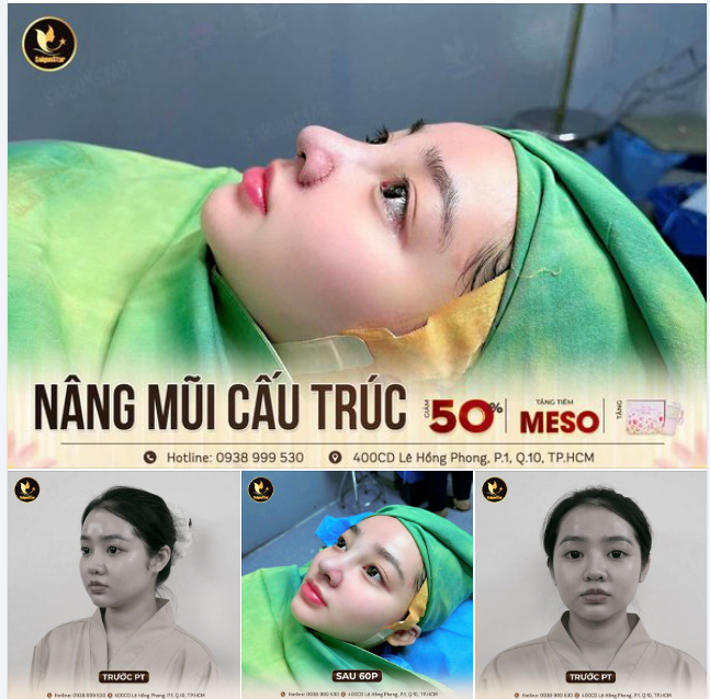 NÂNG MŨI CẤU TRÚC - TÁI LẬP DÁNG MŨI SẮC NÉT