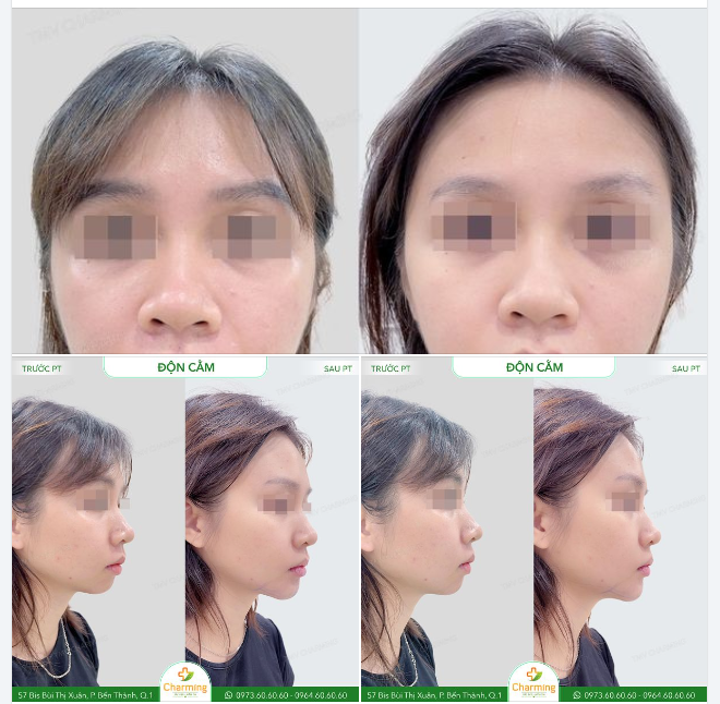Trước khi đến với TMV Charming, nàng gặp phải tình trạng cằm thô và thiếu độ nhô, khiến gương mặt không được thanh thoát và trông mất cân đối.