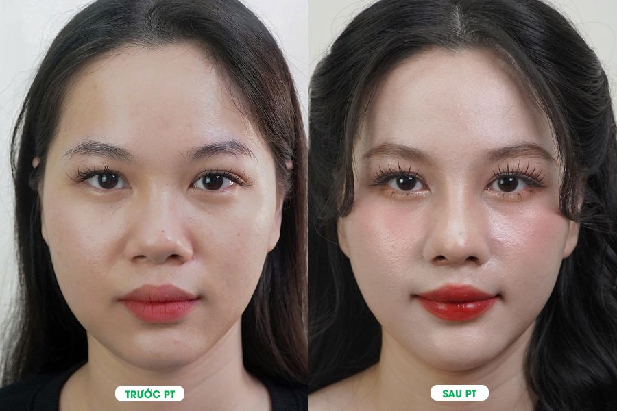 KHÁCH HÀNG TIÊN PHONG TRẢI NGHIỆM NÂNG MŨI 3D SIGNATURE