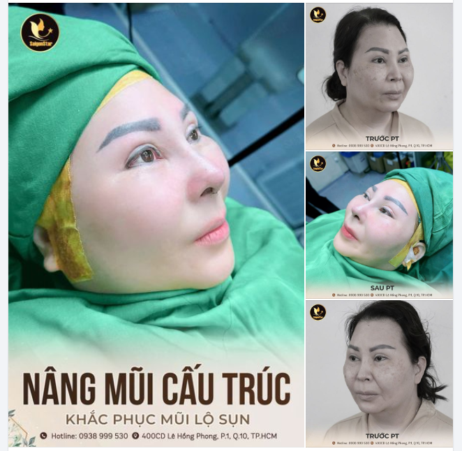 KẾT QUẢ NÂNG MŨI CẤU TRÚC KH. KIMBERLY ANN DO (VIỆT KIỀU MỸ)