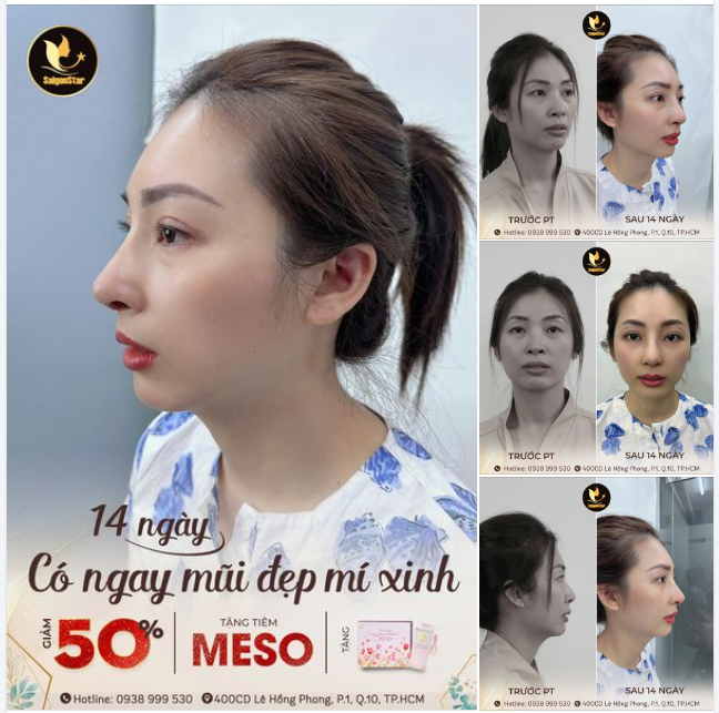 MŨI ĐẸP MÍ XINH CHỈ SAU 14 NGÀY CÙNG COMBO:  NÂNG MŨI CẤU TRÚC SỬA LẠI