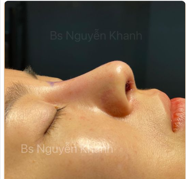Hôm qua bạn đến muốn rút sóng ra bỏ sau 8 năm đặt sóng nhân tạo bên mình.