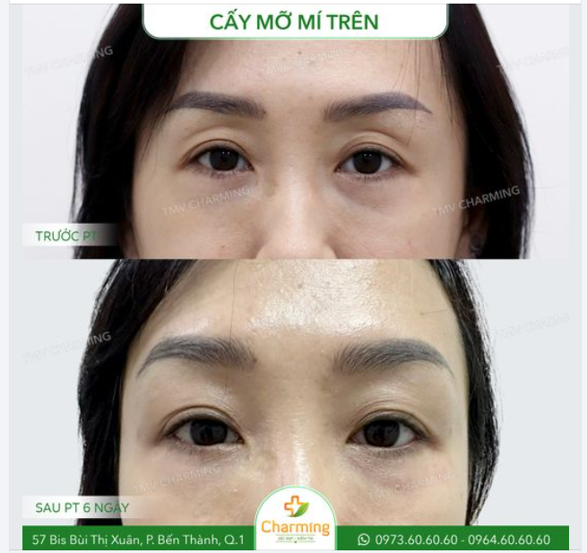 Trước khi thực hiện phẫu thuật cấy mỡ mí trên, nàng khách gặp phải tình trạng hốc mắt sâu, khiến khuôn mặt trông mệt mỏi và thiếu sức sống.