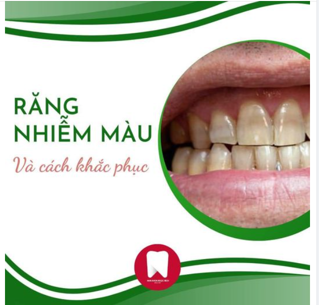 DẤU HIỆU RĂNG NHIỄM MÀU DO KHÁNG SINH CÁCH KHẮC PHỤC