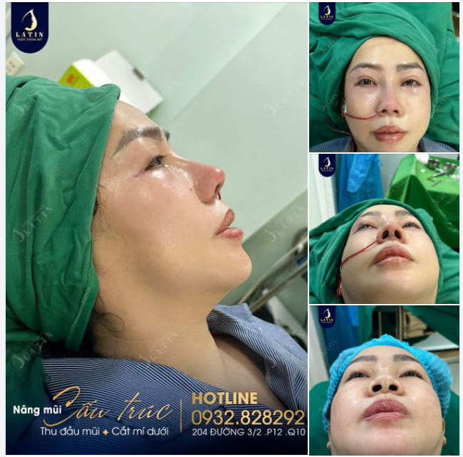Hoàn thành ca nâng mũi, cắt mí dưới cho chị khách hàng cũ
