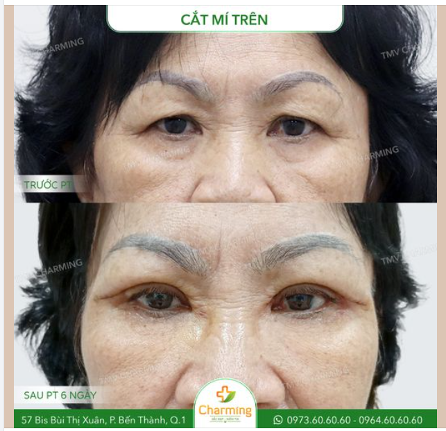 Trước khi đến TMV Charming, cô khách gặp phải tình trạng mí mắt trên sụp xệ do lão hóa, khiến đôi mắt trông mệt mỏi và kém linh hoạt.