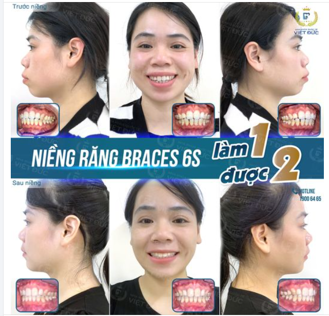 MỪNG NGÀY THÁO NIỀNG: KHÁCH HÀNG PHẠM THỊ TÂM NIỀNG RĂNG KHÔNG PHÂN BIỆT TUỔI TÁC