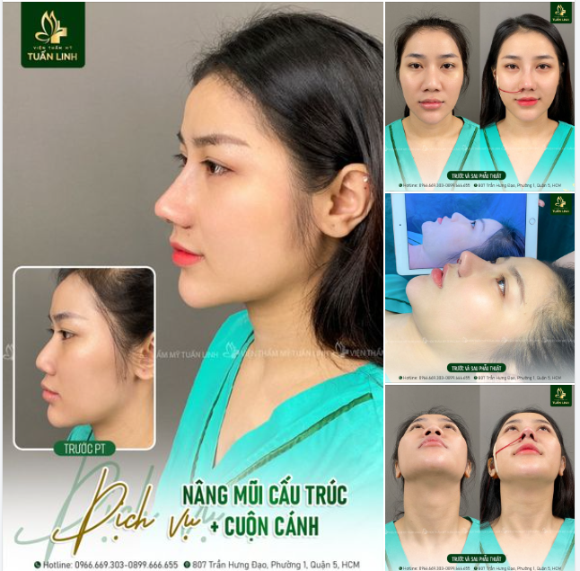 NÂNG MŨI CẤU TRÚC KẾT HỢP CUỘN CÁNH - SỞ HỮU CHIẾC MŨI HOÀN HẢO TỪ MỌI GÓC NHÌN!