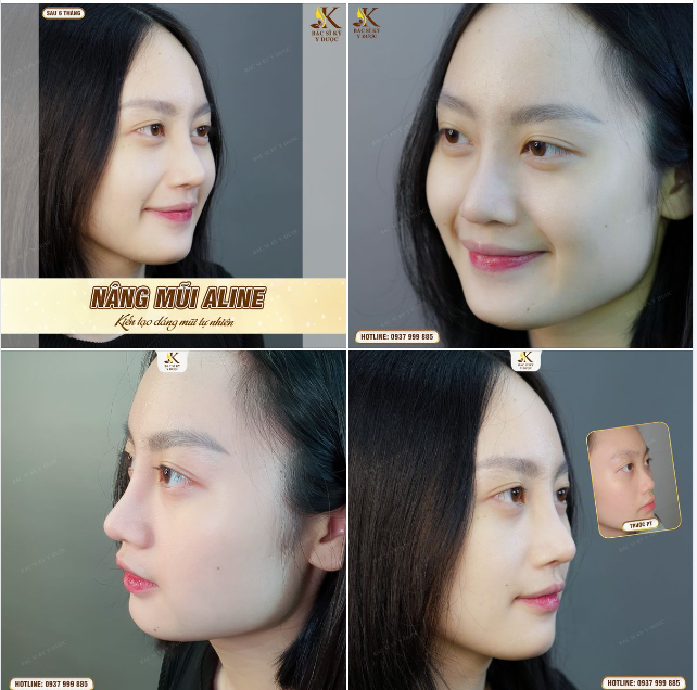 Sau NÂNG MŨI ALINE, nhìn bạn ấy cứ làm sao á
