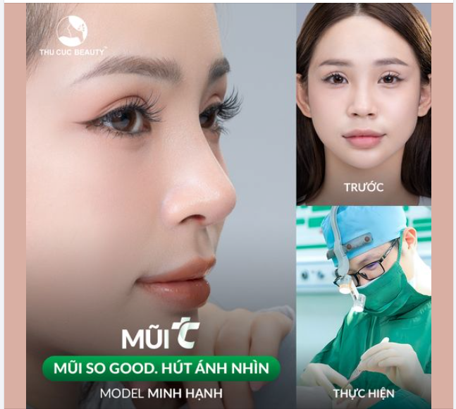 Dáng mũi thấp tẹt đang "phong ấn" nhan sắc của bạn Chọn Mũi TC