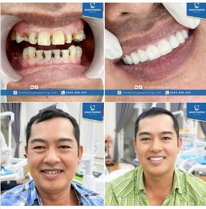 Sâu kẽ, ố vàng, mòn mẻ, tất cả đều được khắc phục chỉ sau 3 ngày