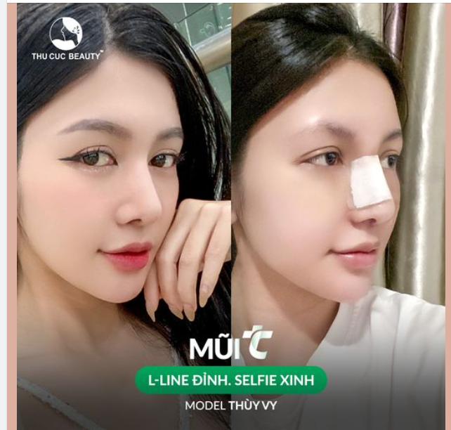 Đỉnh cao của nâng mũi L- Line