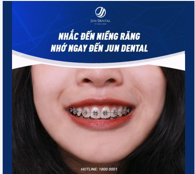 NHẮC ĐẾN NIỀNG RĂNG - NHỚ NGAY ĐẾN JUN DENTAL