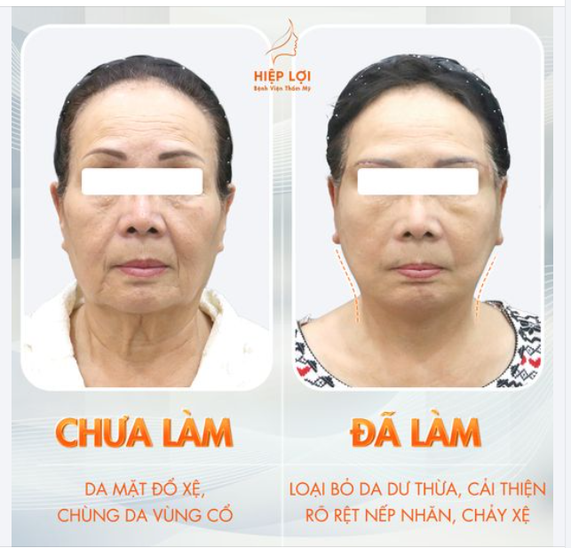 Căng da mặt toàn phần - Kết quả rõ rệt chỉ sau 1 lần thực hiện