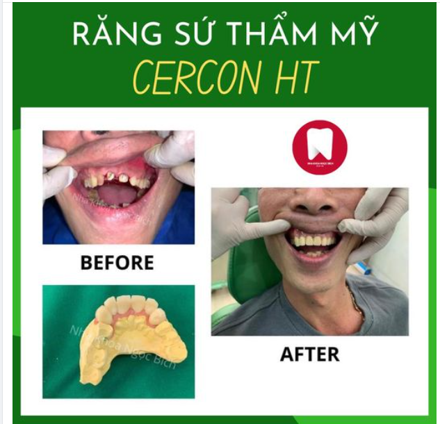 CẦU CHỤP SỨ CERCON HT - GIẢI PHÁP TỐI ƯU