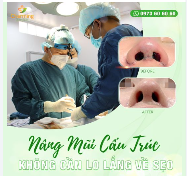 NÂNG MŨI CẤU TRÚC: KHÔNG CẦN LO LẮNG VỀ SẸO