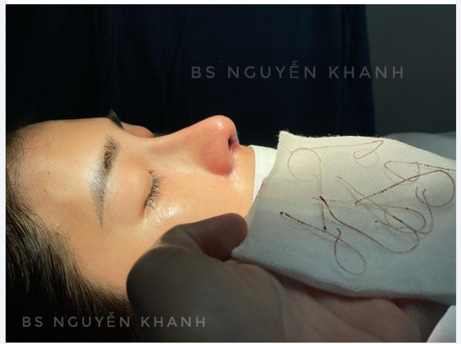 NÂNG MŨI BẰNG CHỈ - NGUY CƠ TIỀM ẨN BẠN CẦN BIẾT