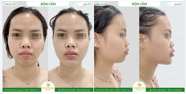 Nàng khách trước khi phẫu thuật luôn cảm thấy thiếu tự tin với gương mặt của mình do phần cằm thiếu độ nhô, khiến tổng thể khuôn mặt trông không cân đối và hài hòa.
