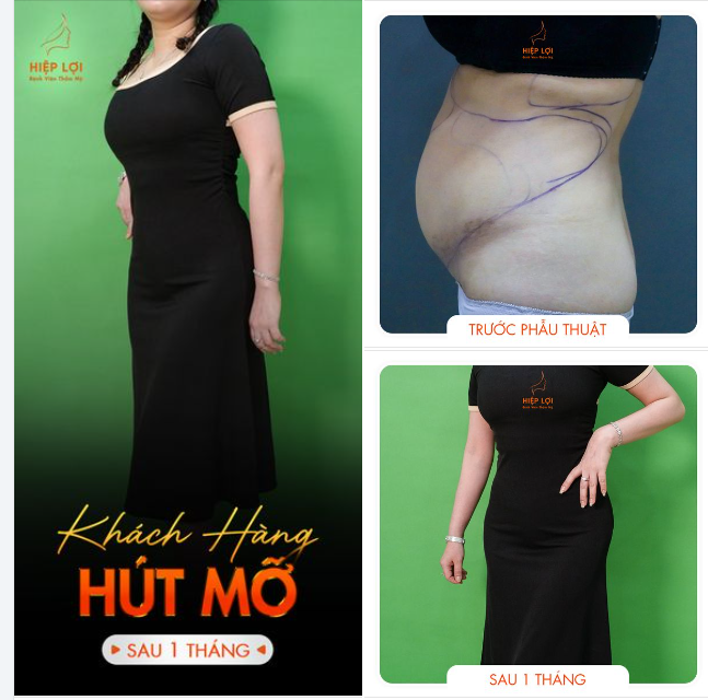 Kết Quả Thon Gọn Sau 1 Tháng - Chỉ 1 lần thực hiện