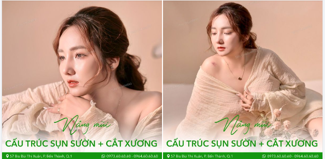 Nàng khách trong ảnh đã lựa chọn nâng mũi cấu trúc sụn sườn và cắt xương, tạo nên một diện mạo thanh tú và vô cùng tự nhiên.
