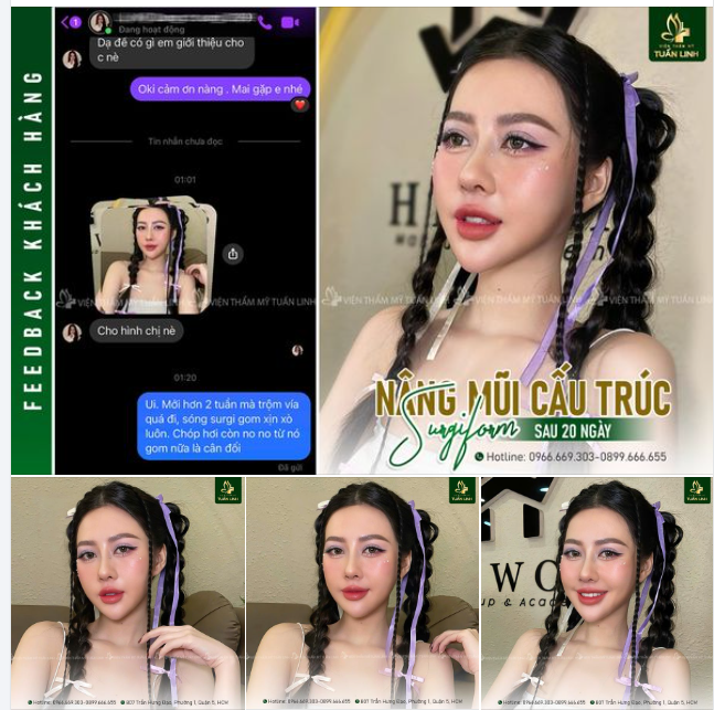 Feedback sau 20 ngày nâng mũi cấu trúc Surgiform – Đẹp xuất sắc!