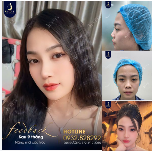 Nâng mũi xong em rất hối hận...  Hối hận vì đã không nâng mũi sớm hơn.