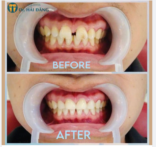 ĐIỀU TRỊ RĂNG THƯA DUY NHẤT CHỈ VỚI 30 PHÚT
