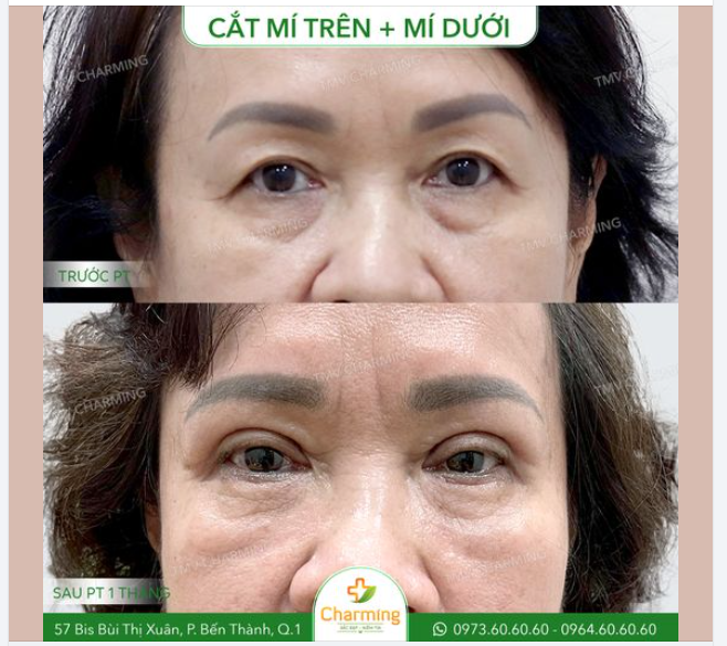 Cô khách đã bước vào tuổi trung niên và gặp vấn đề với đôi mí mắt không đều, da chùng nhiều khiến gương mặt trở nên mệt mỏi.