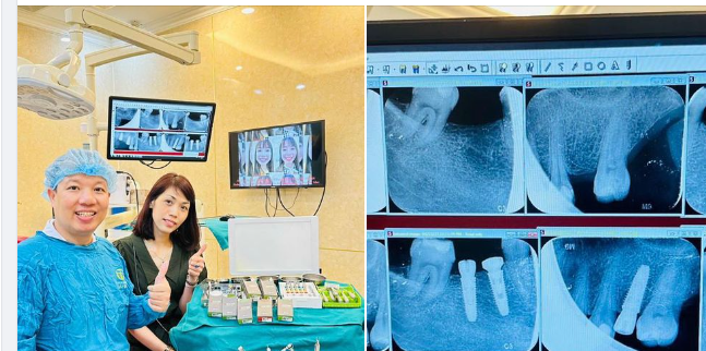 TRỌN GÓI TRỒNG RĂNG IMPLANT CHỈ 7.200.000 VNĐ